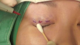 Video1_三點微切口割雙眼皮_Pic