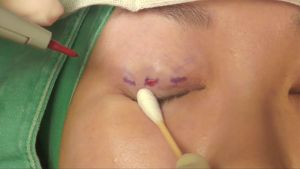 Video1_三點微切口割雙眼皮_Pic