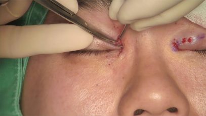 Video2_開眼頭_Pic