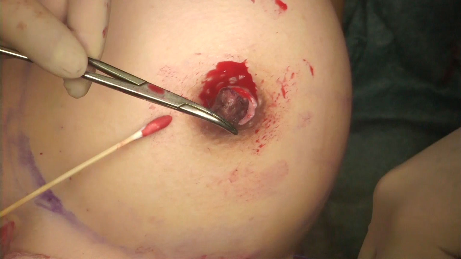 Video4_乳頭縮小-Pic