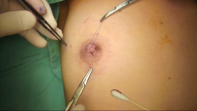 Video5_乳頭凹陷矯正_Pic