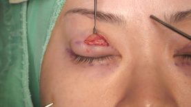 double eyelid surgery taiwan cost