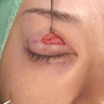 Half-Incisional Double Eyelid Surgery