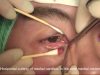 Epicanthoplasty (Medial canthoplasty) W-plasty method