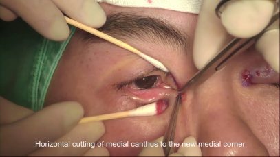 Epicanthoplasty (Medial canthoplasty) W-plasty method