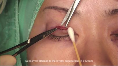 Half-Incisional Double Eyelid Surgery