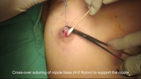 Inverted Nipple Correction (Buried Suturing Technique)