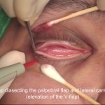 Lateral Canthoplasty / Canthopexy Y-V Flap Method (Male)