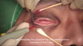 Lateral canthoplasty/canthopexy Y-V flap method (male)