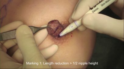Nipple Reduction