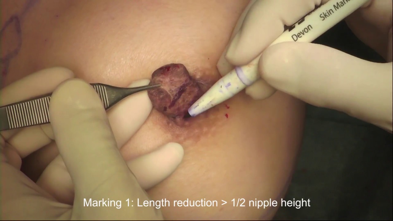 Nipple Reduction