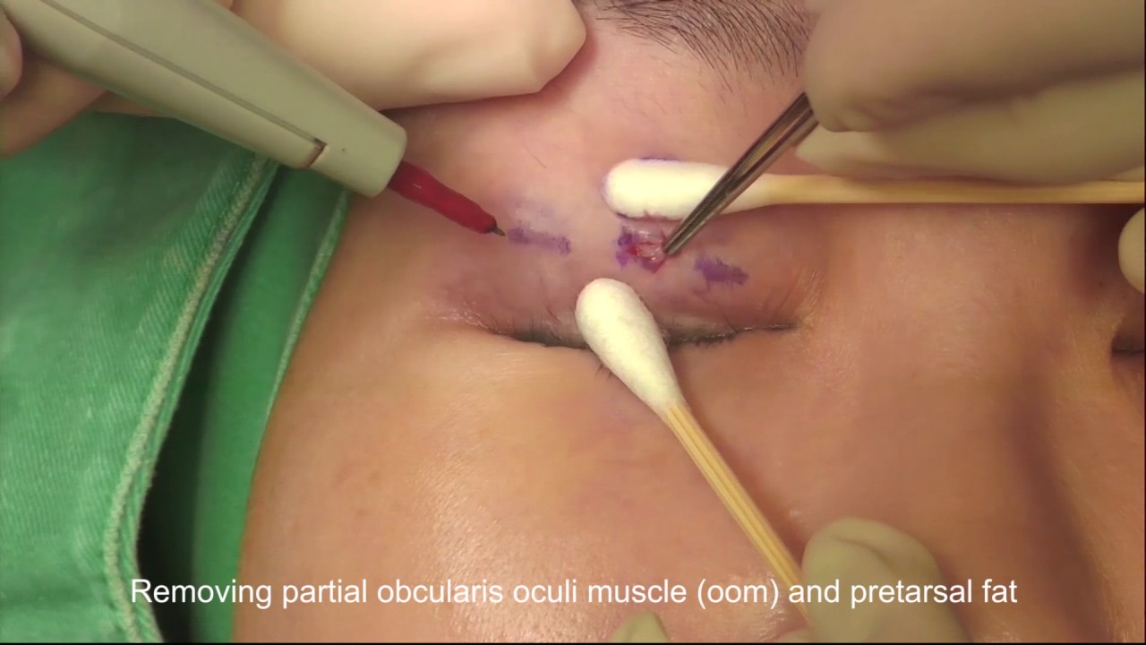 Triple Micro-Incisional Double Eyelid Surgery
