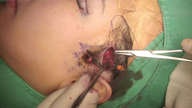 Vedio7_Temporal mid-face lift_Pic