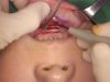 Video10_Chin-Augmentation(Medpor-chin-implant)_Pic