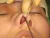Video8_Revision-Closed-Rhinoplasty_Pic