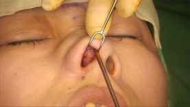 Video8_Revision-Closed-Rhinoplasty_Pic