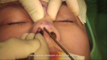 Revision Closed Rhinoplasty (L Type Implant Revision)