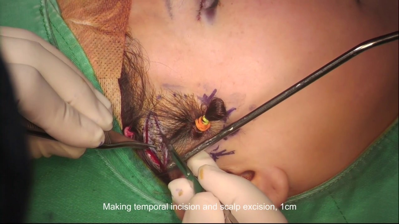 Temporal Mid Face Lift