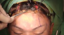 Video11_Endoscopic-Brow-Lift-Using-Endotine-Fixation-Technique(Advanced-4-Incision-Method)_Pic
