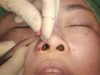 Video13_Alar-composite-graft-for-correction-of-nostril-exposure_Pic
