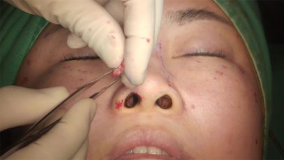 Video13_Alar-composite-graft-for-correction-of-nostril-exposure_Pic