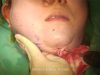Video9_Ultrasonic-Liposuction-Of-Chin-And-Jowl_Pic