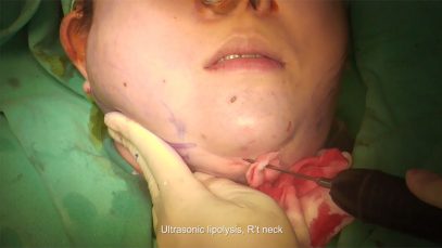 Video9_Ultrasonic-Liposuction-Of-Chin-And-Jowl_Pic