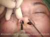 Alar Composite Graft For Correction Of Nostril Exposure