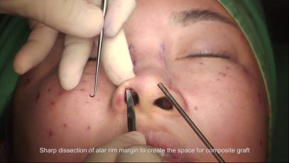 Alar Composite Graft For Correction Of Nostril Exposure