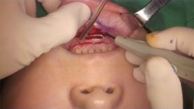 Chin Augmentation (Medpor Chin Implant)