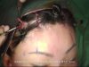 Endoscopic Brow Lift With Endotine Fixation (Advanced 4 Incision Technique)