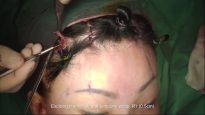 Endoscopic Brow Lift With Endotine Fixation (Advanced 4 Incision Technique)