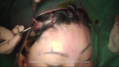 Endoscopic Brow Lift With Endotine Fixation (Advanced 4 Incision Technique)