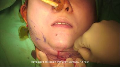 Ultrasonic Liposuction Of Chin And Jowl