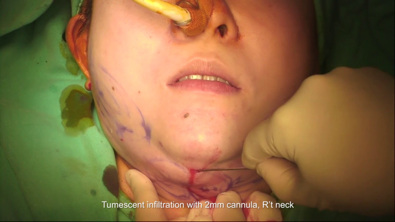 Ultrasonic Liposuction Of Chin And Jowl