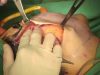 Video12_High-SMAS-Facelift_Pic