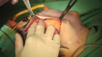 Video12_High-SMAS-Facelift_Pic