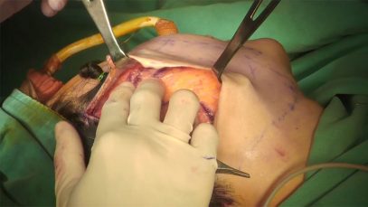 Video12_High-SMAS-Facelift_Pic