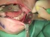 Video14_Mandible-Angle-Splitting-Osteotomy_Pic