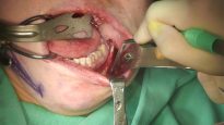 Video14_Mandible-Angle-Splitting-Osteotomy_Pic