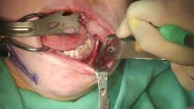 Video14_Mandible-Angle-Splitting-Osteotomy_Pic