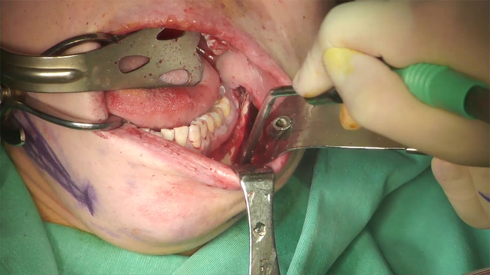 Video14_Mandible-Angle-Splitting-Osteotomy_Pic