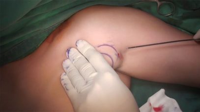 Video15_Liposuction-Of-Accessory-Breasts_Pic