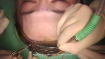 Video16_Forehead-Augmentation-(Silicone-Implant)_Pic