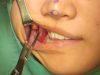 Video18_Buccal-Fat-Pad-Removal_Pic