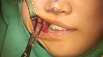 Video18_Buccal-Fat-Pad-Removal_Pic