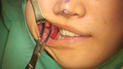 Video18_Buccal-Fat-Pad-Removal_Pic