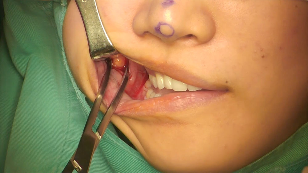 https://learningplasticsurgery.com/wp-content/uploads/2017/09/Video18_Buccal-Fat-Pad-Removal_Pic.jpg