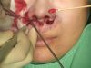 Video19_Philtrum-Reduction-(Upper-Lip-Lift)_Pic