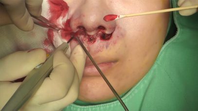 Video19_Philtrum-Reduction-(Upper-Lip-Lift)_Pic